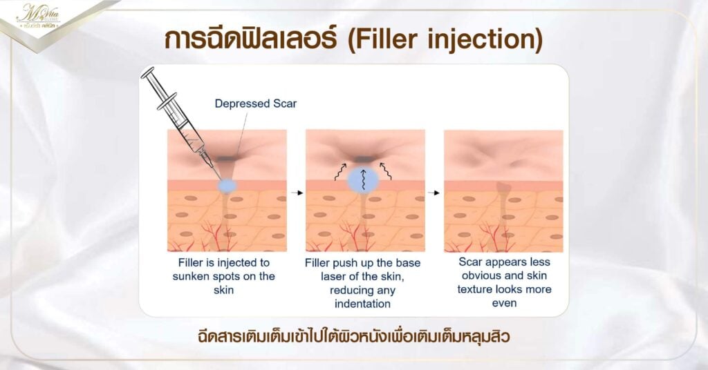 ฉีดเติมเต็มหลุมสิว