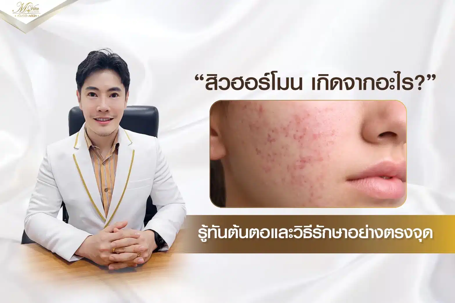 สิวฮอร์โมน เกิดจากอะไร