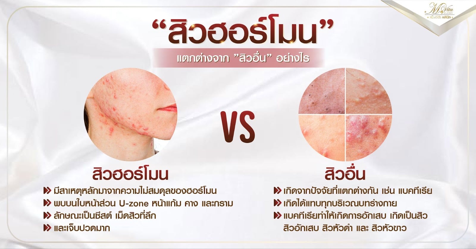 สิวฮอร์โมนแตกต่างจากสิวอื่นอย่างไร