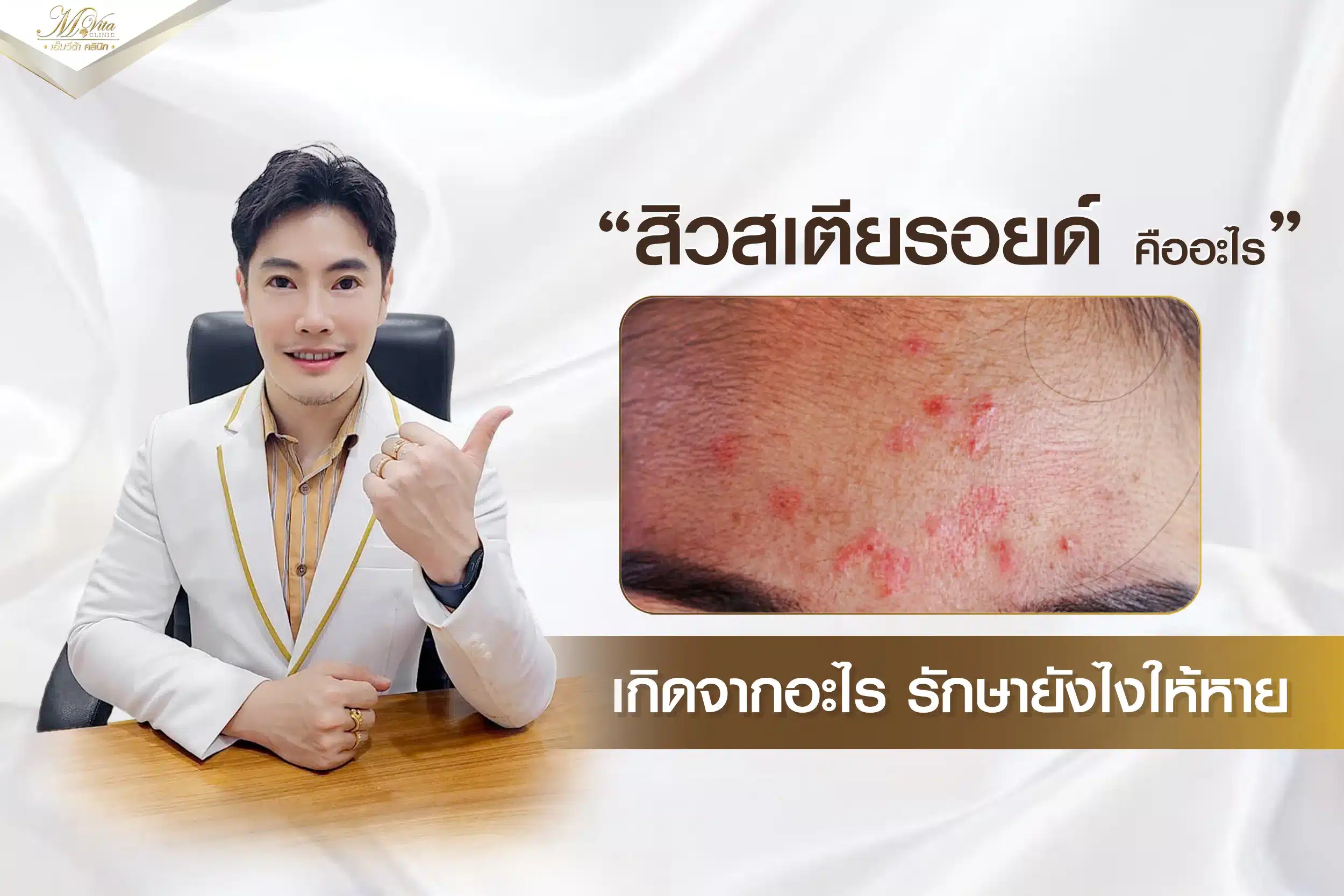 สิวสเตียรอยด์ สิวติดสาร รักษายังไงให้หาย?