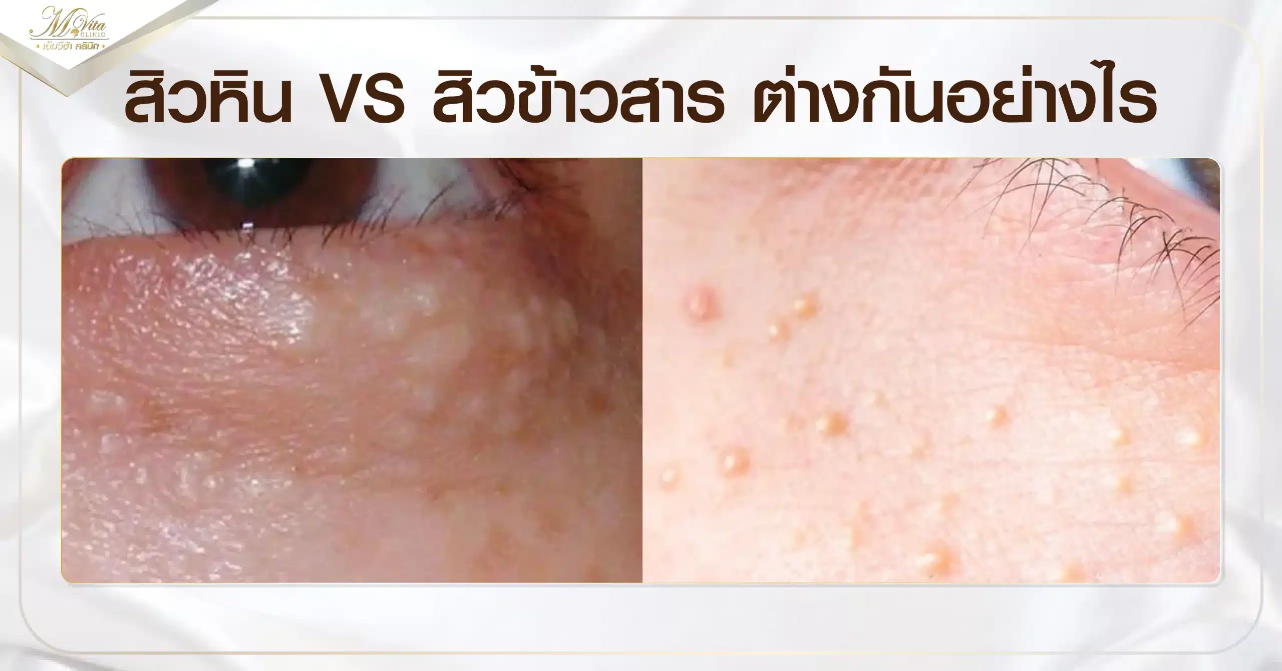 สิวหิน VS สิวข้าวสาร ต่างกันอย่างไร