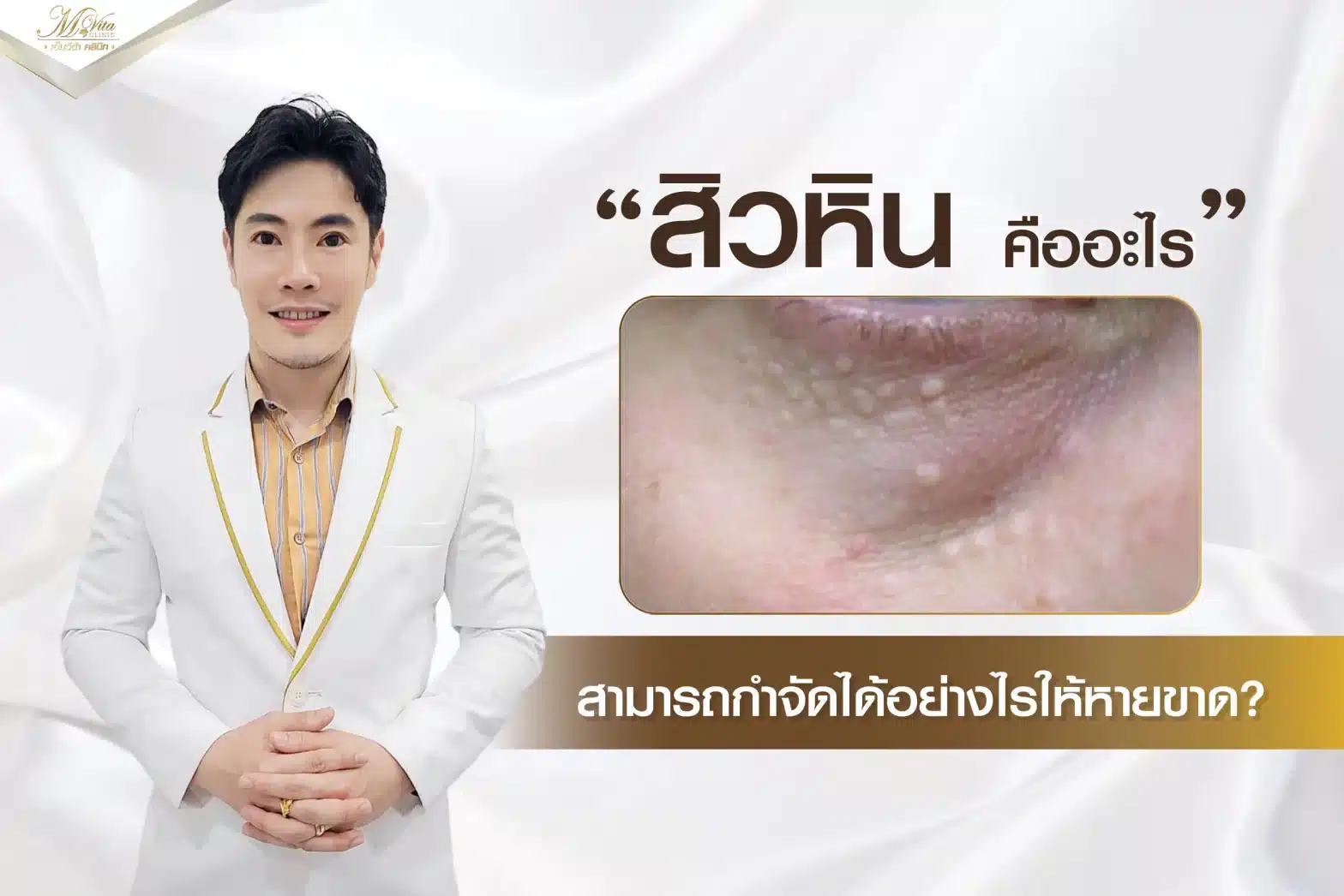 สิวหินคืออะไร2.1