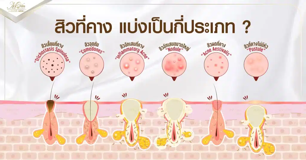 ชนิดสิวที่คาง