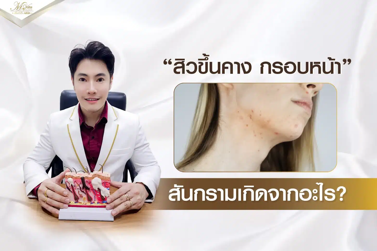 สิวขึ้นคาง กรอบหน้าเกิดจากอะไร