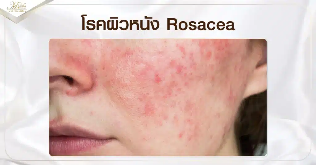 โรคผิวหนัง Rosacea