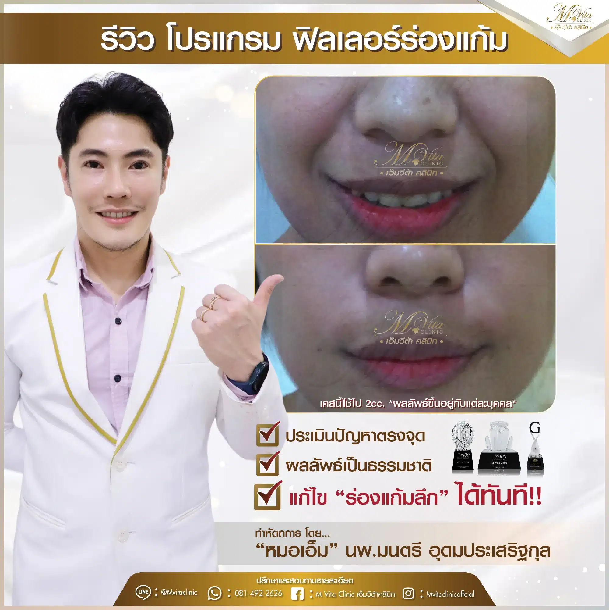 ฟิลเลอร์ร่องแก้ม