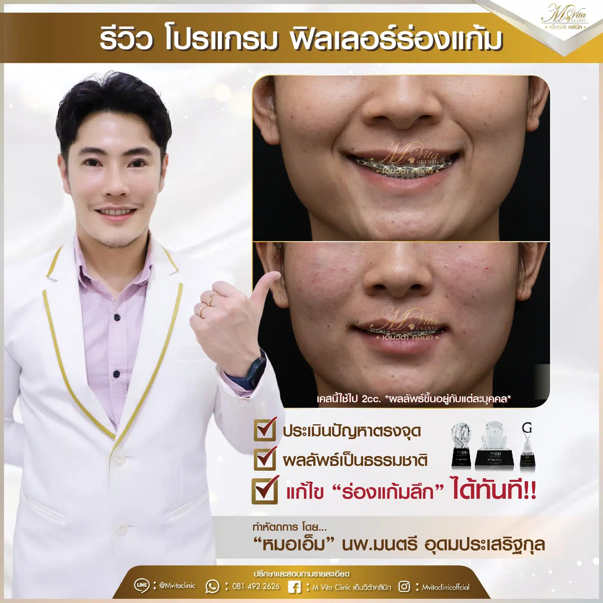 ฟิลเลอร์ร่องแก้ม