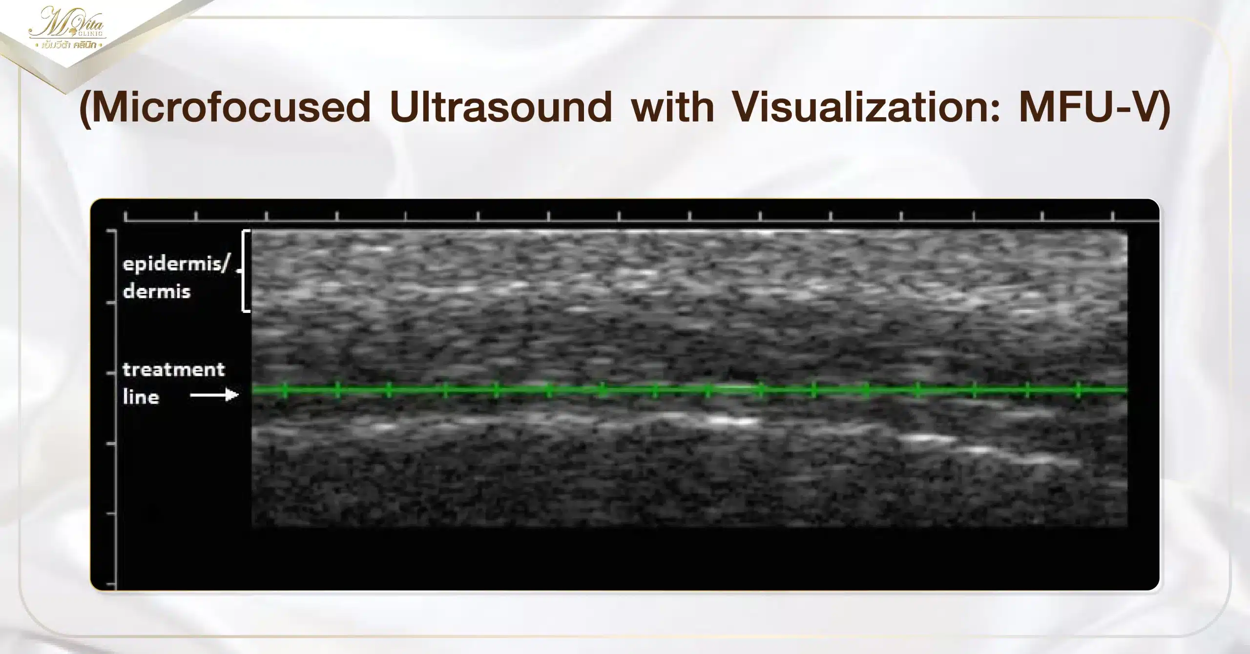 Microfocused Ultrasound