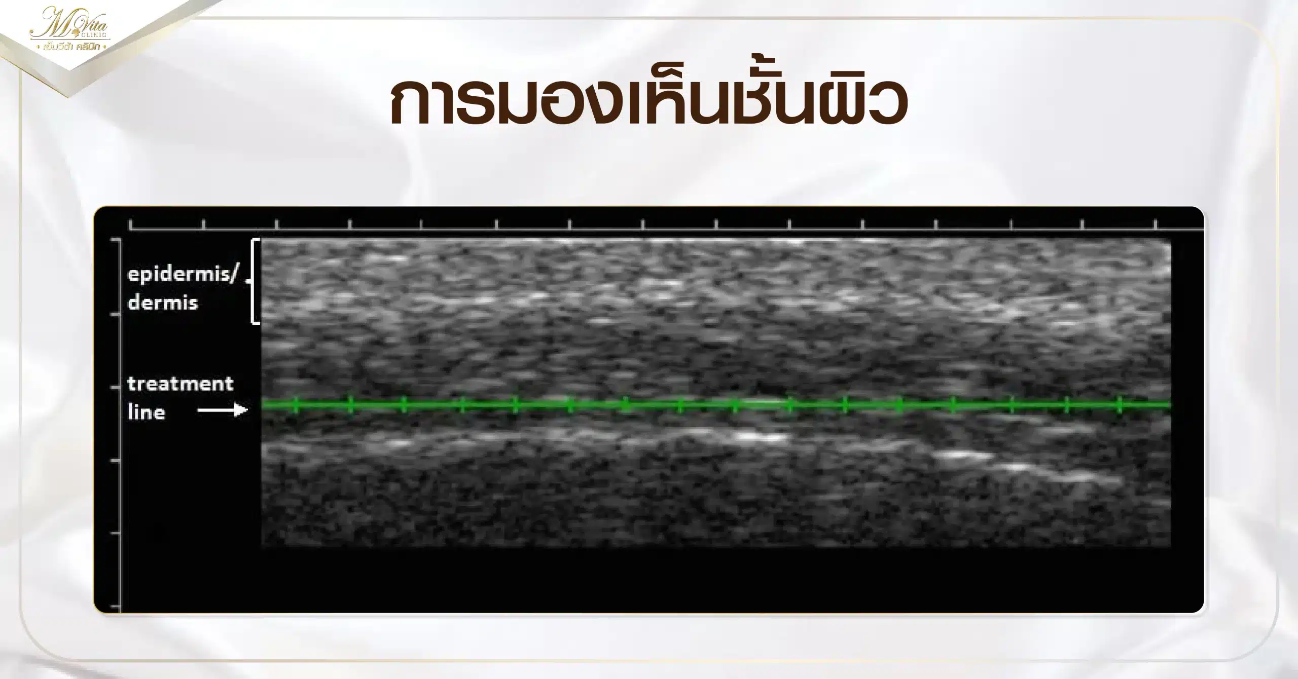 การมองเห็นชั้นผิว