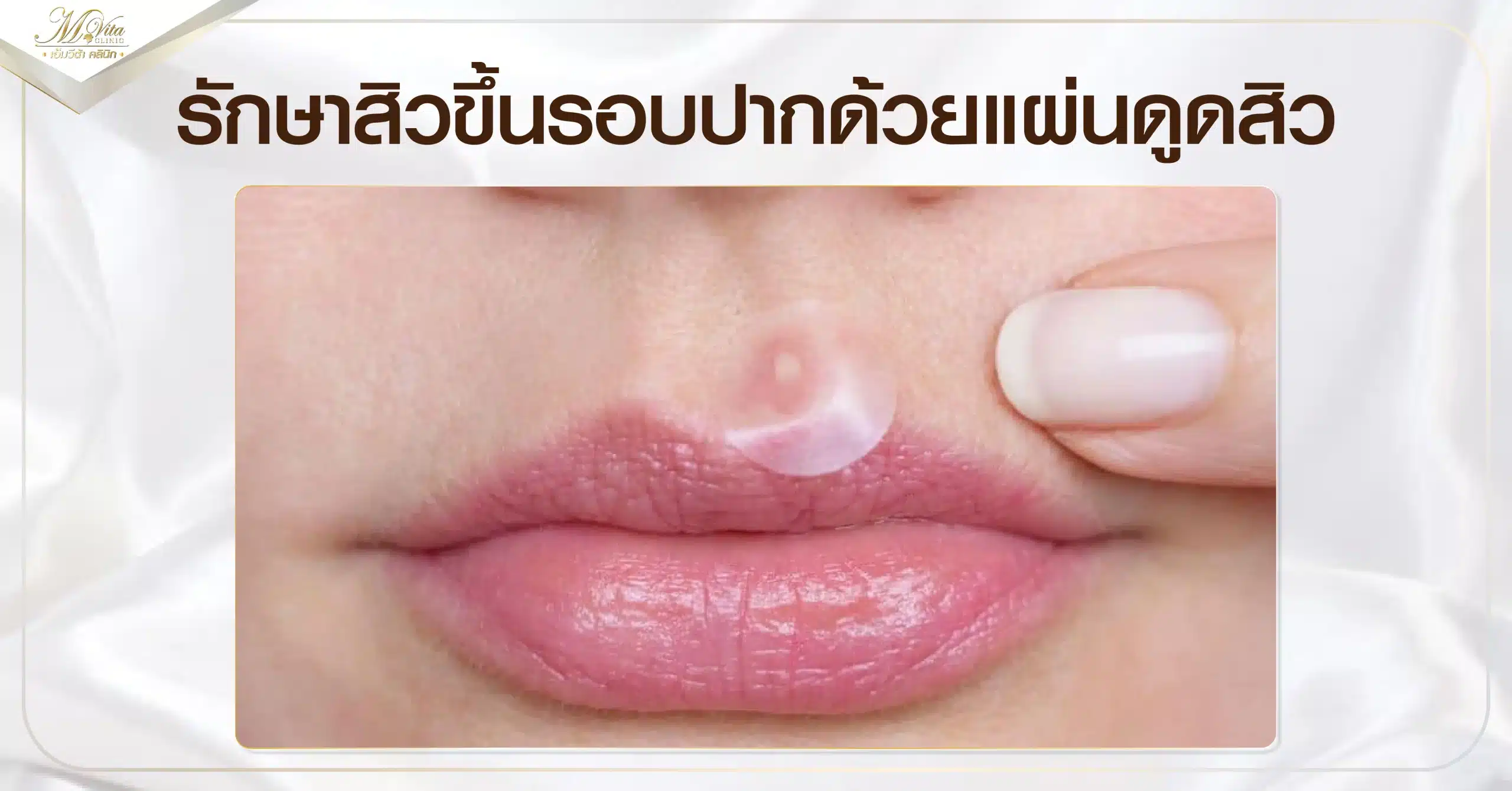 รักษาสิวขึ้นรอบปากด้วยแผ่นดูดสิว