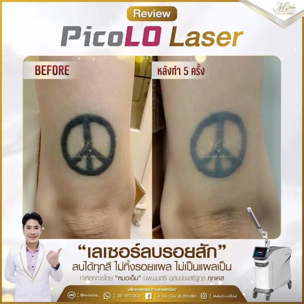 รีวิว pico laser-01