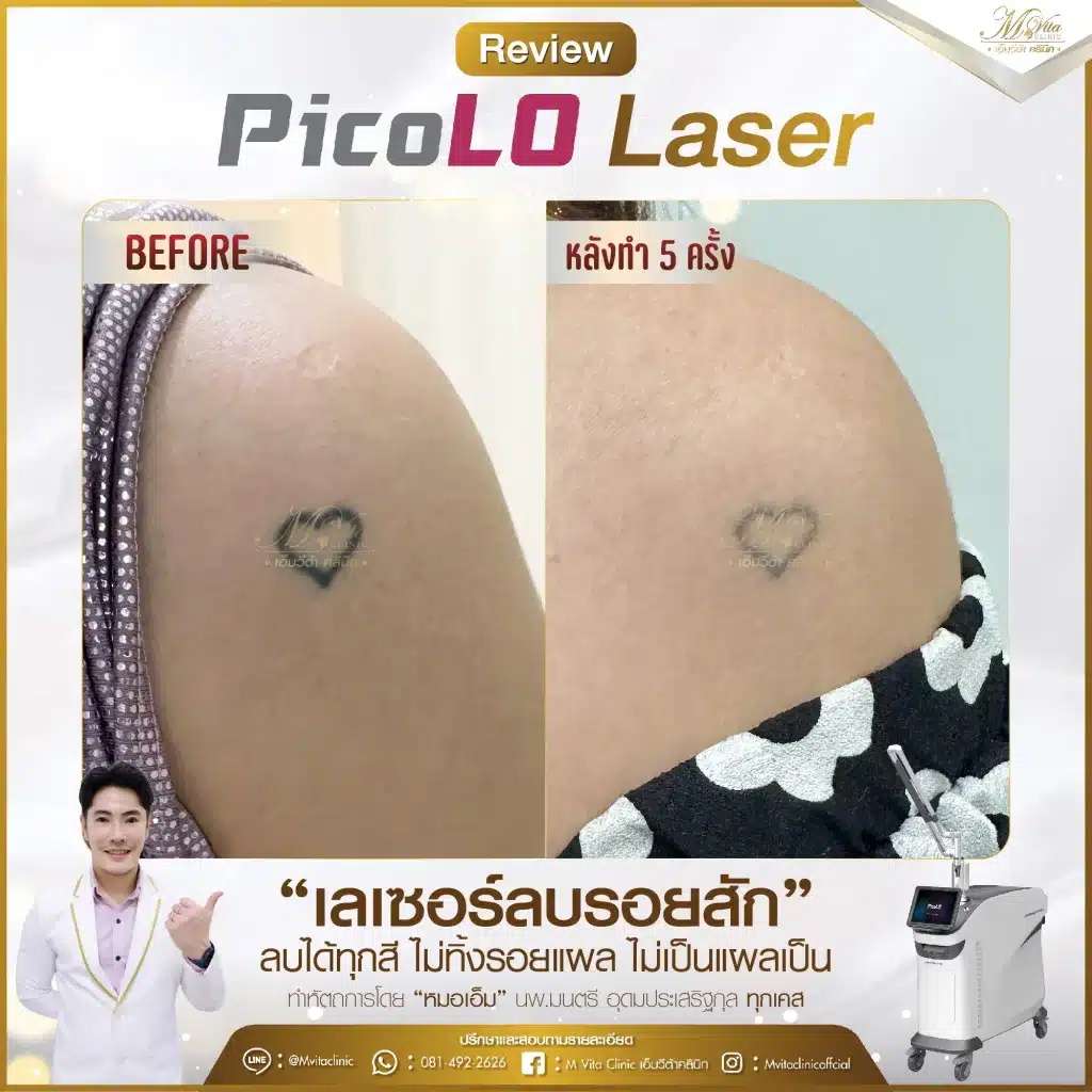 รีวิว pico laser 2-01