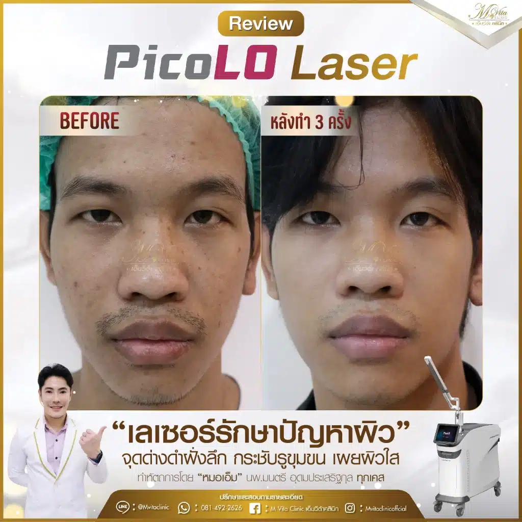 รีวิว pico laser-4-01