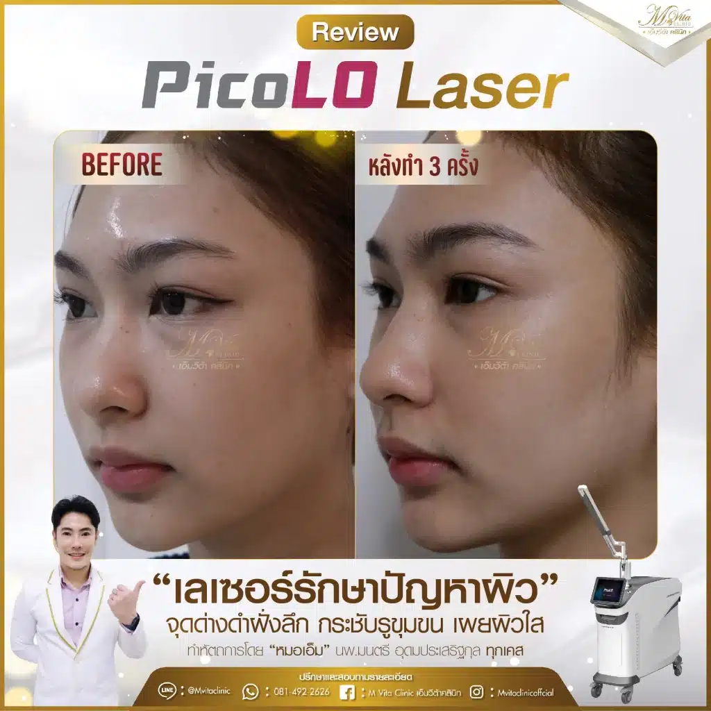 รีวิว pico laser 5-01