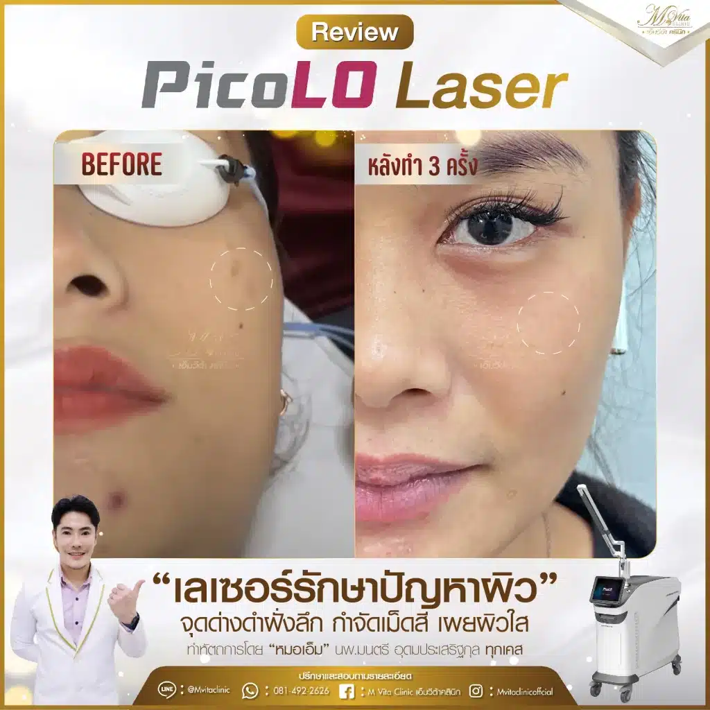 รีวิว pico laser เลเซอร์รอย-01