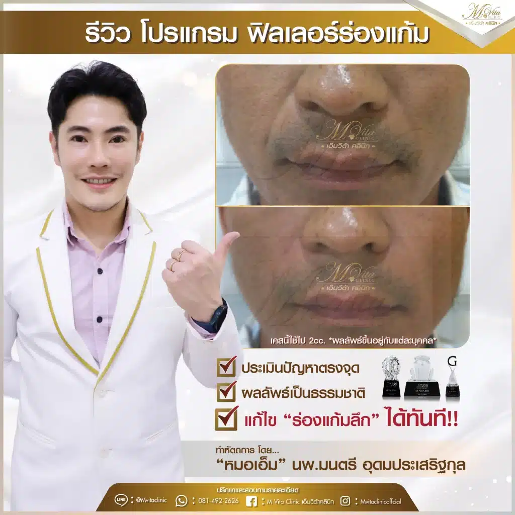 รีวิว ฟิลเลอร์ร่องแก้ม 1-01