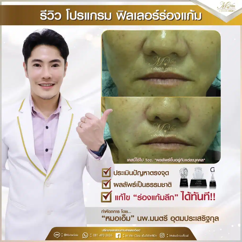 รีวิว ฟิลเลอร์ร่องแก้ม 2-01