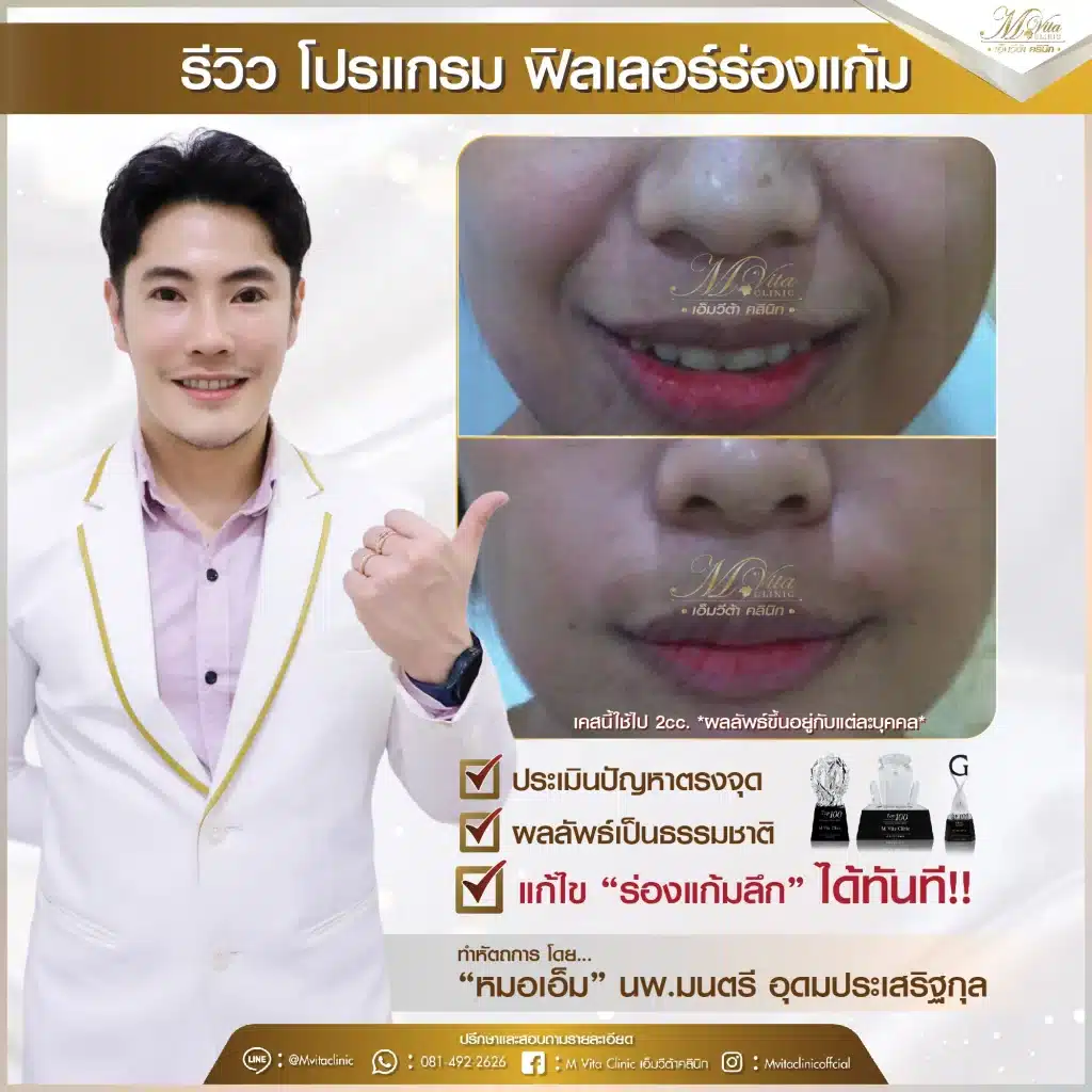 รีวิว ฟิลเลอร์ร่องแก้ม 3-01