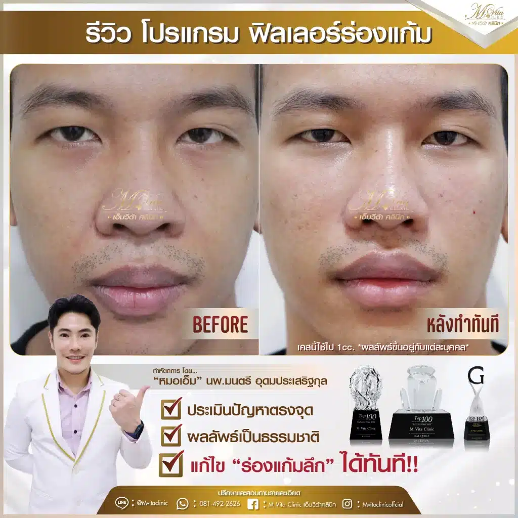 รีวิว ฟิลเลอร์ร่องแก้ม 4-01