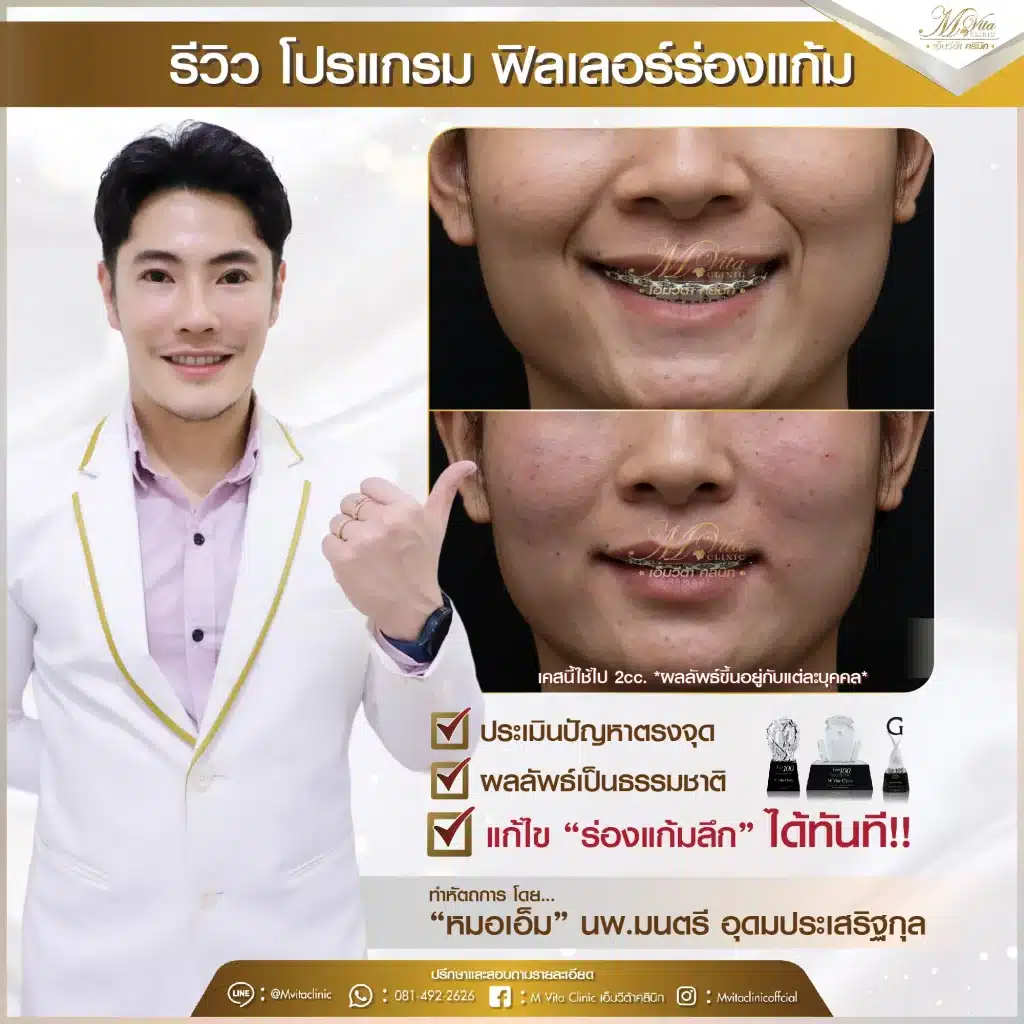 รีวิว ฟิลเลอร์ร่องแก้ม 5