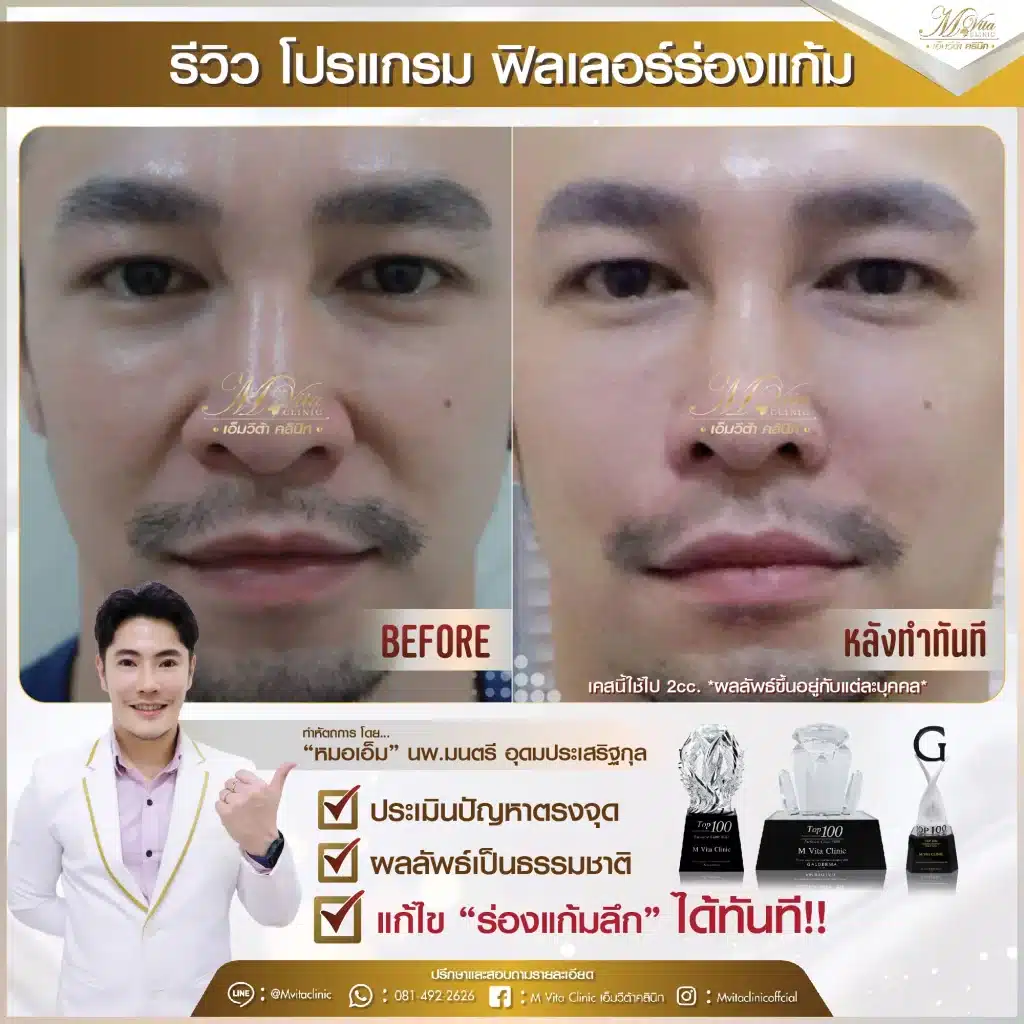 รีวิว ฟิลเลอร์ร่องแก้ม คุณเอก-01