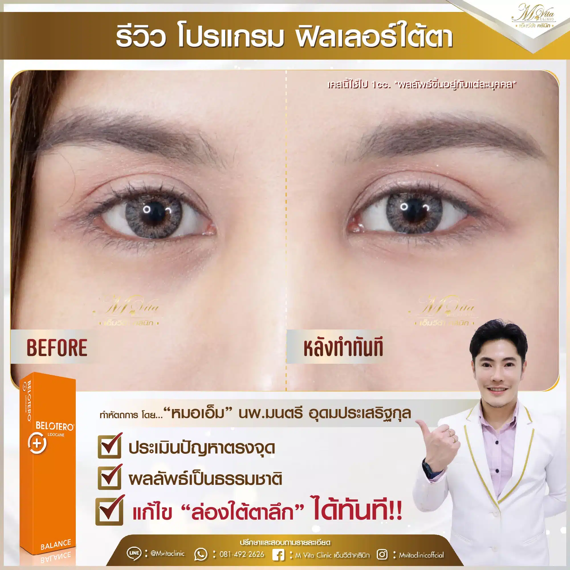 รีวิว ฟิลเลอร์ใต้ตา-01