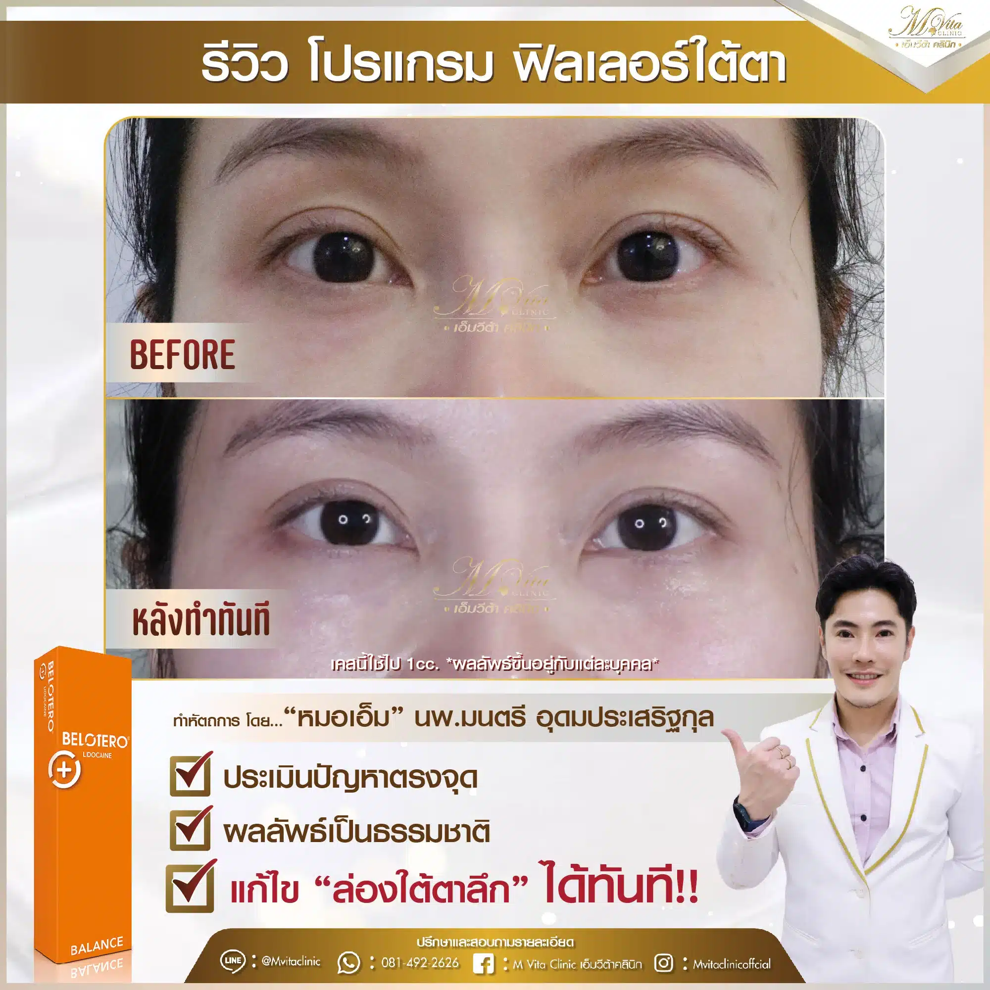 รีวิว ฟิลเลอร์ใต้ตา คุณตุ้ก-01