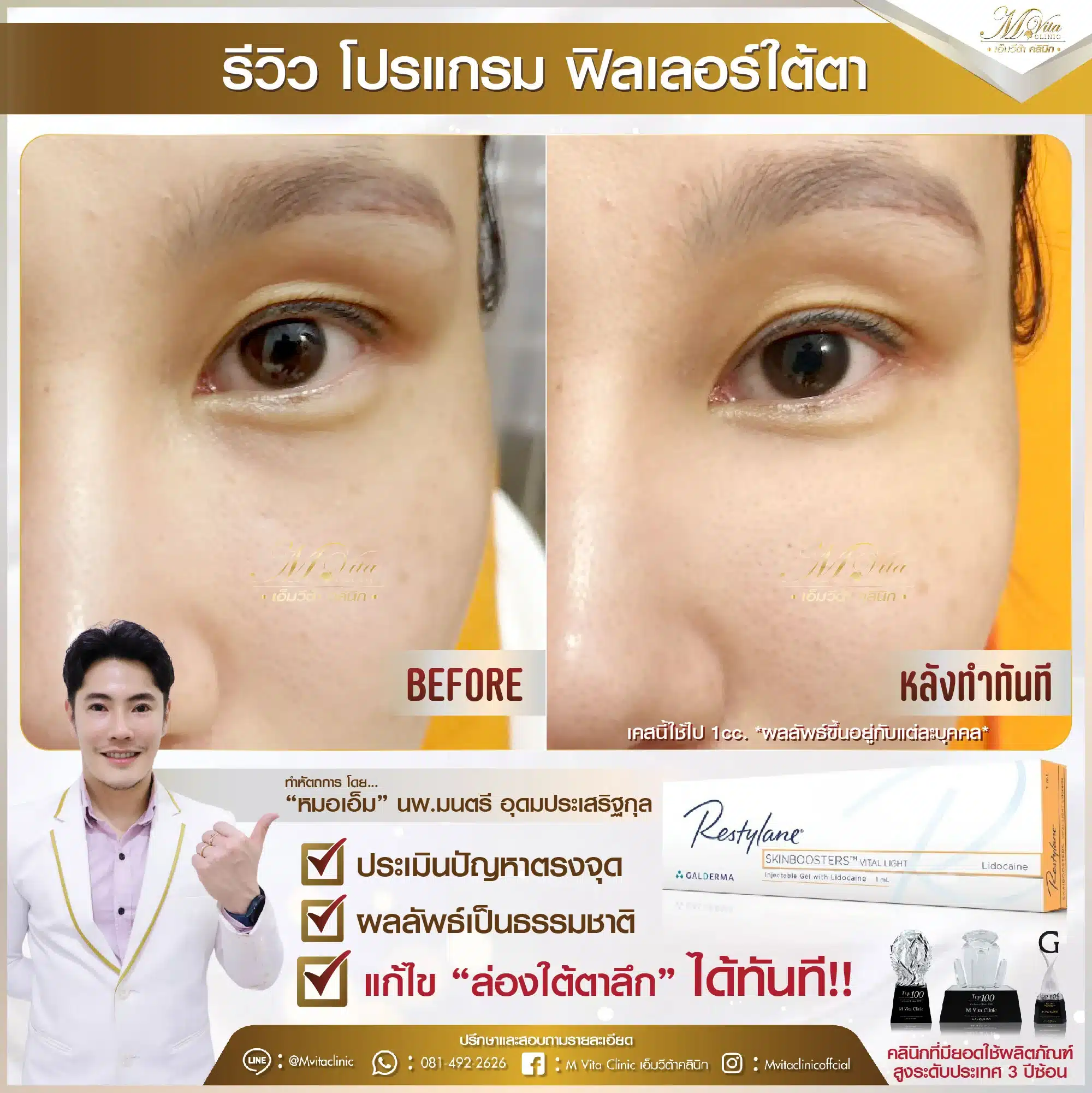 รีวิว ฟิลเลอร์ใต้ตา คุณพลอย-01