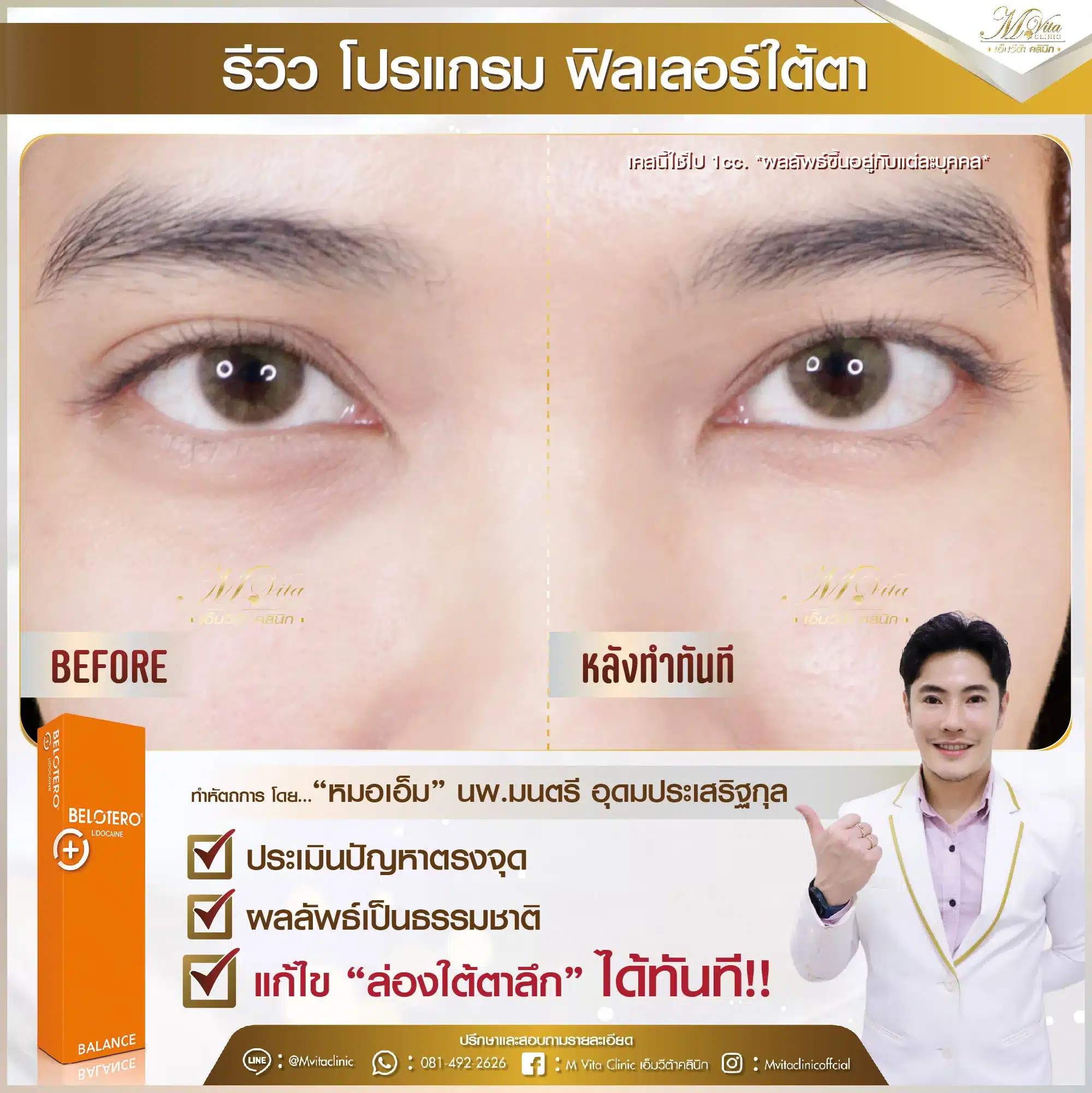 รีวิว ฟิลเลอร์ใต้ตา คุณฟิล์ม-01