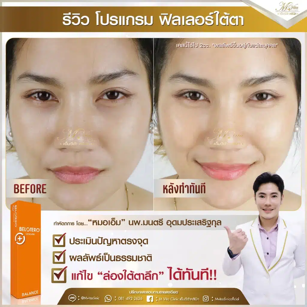 รีวิว ฟิลเลอร์ใต้ตา คุณส้ม ศศิธร พิมพา-01