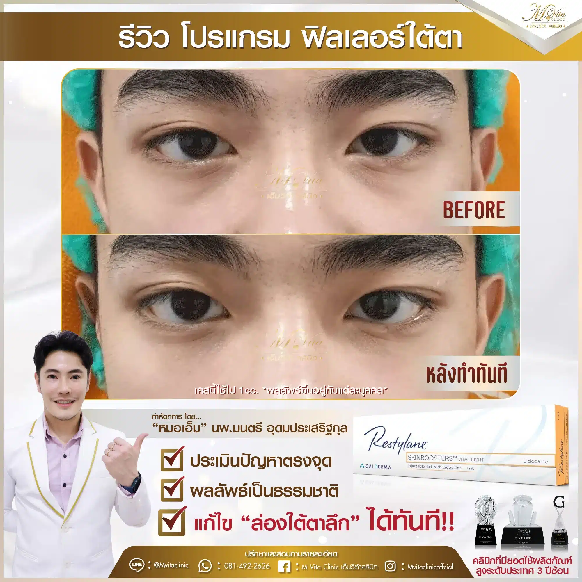 รีวิว ฟิลเลอร์ใต้ตา คุณเจิ้ง-01