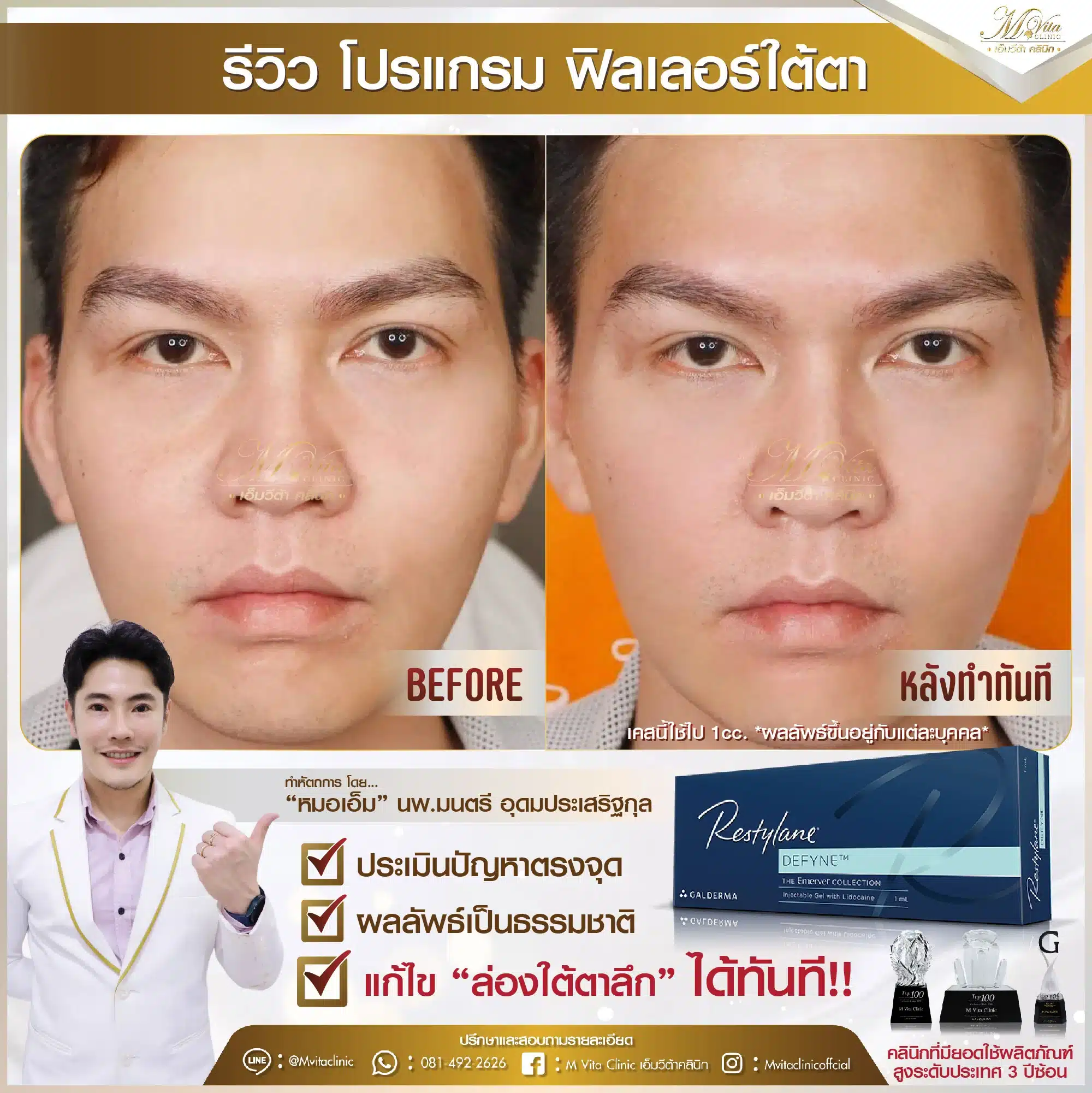 รีวิว ฟิลเลอร์ใต้ตา คุณเอก-01