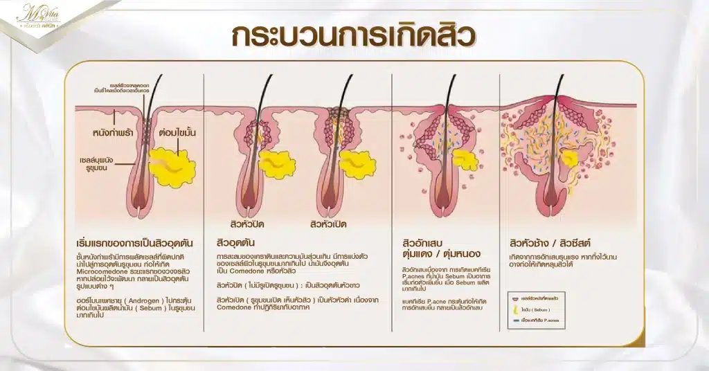 สาเหตุการเกิดสิว