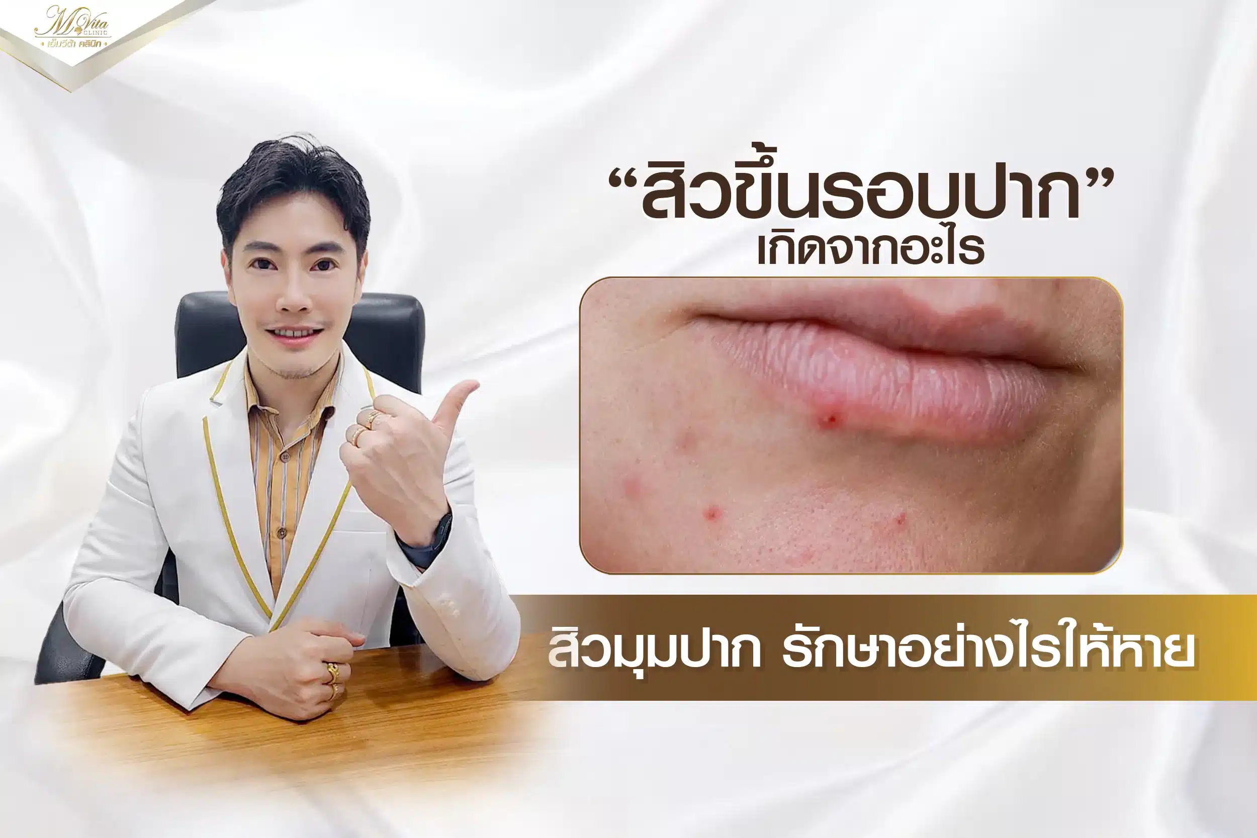 รวมเรื่องที่ควรรู้! สิวขึ้นรอบปาก เกิดจากอะไร รักษาอย่างไรให้ได้ผลที่สุด