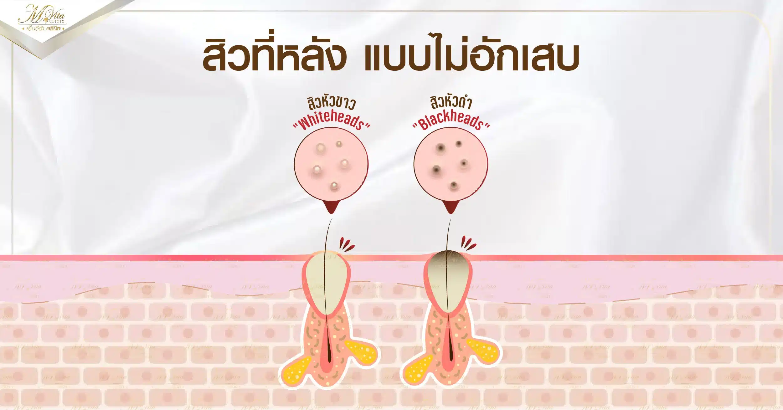 สิวที่หลัง แบบไม่อักเสบ