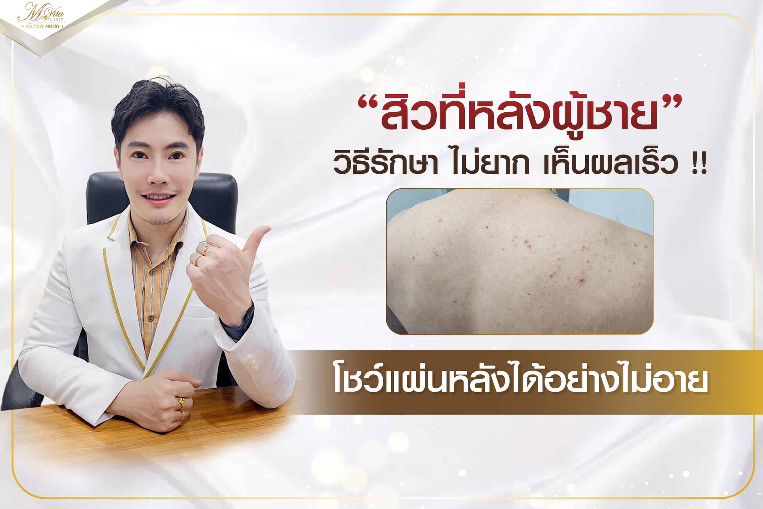 สิวที่หลังผู้ชาย วิธีรักษา ไม่ยาก เห็นผลเร็ว !! โชว์แผ่นหลังได้อย่างไม่อาย