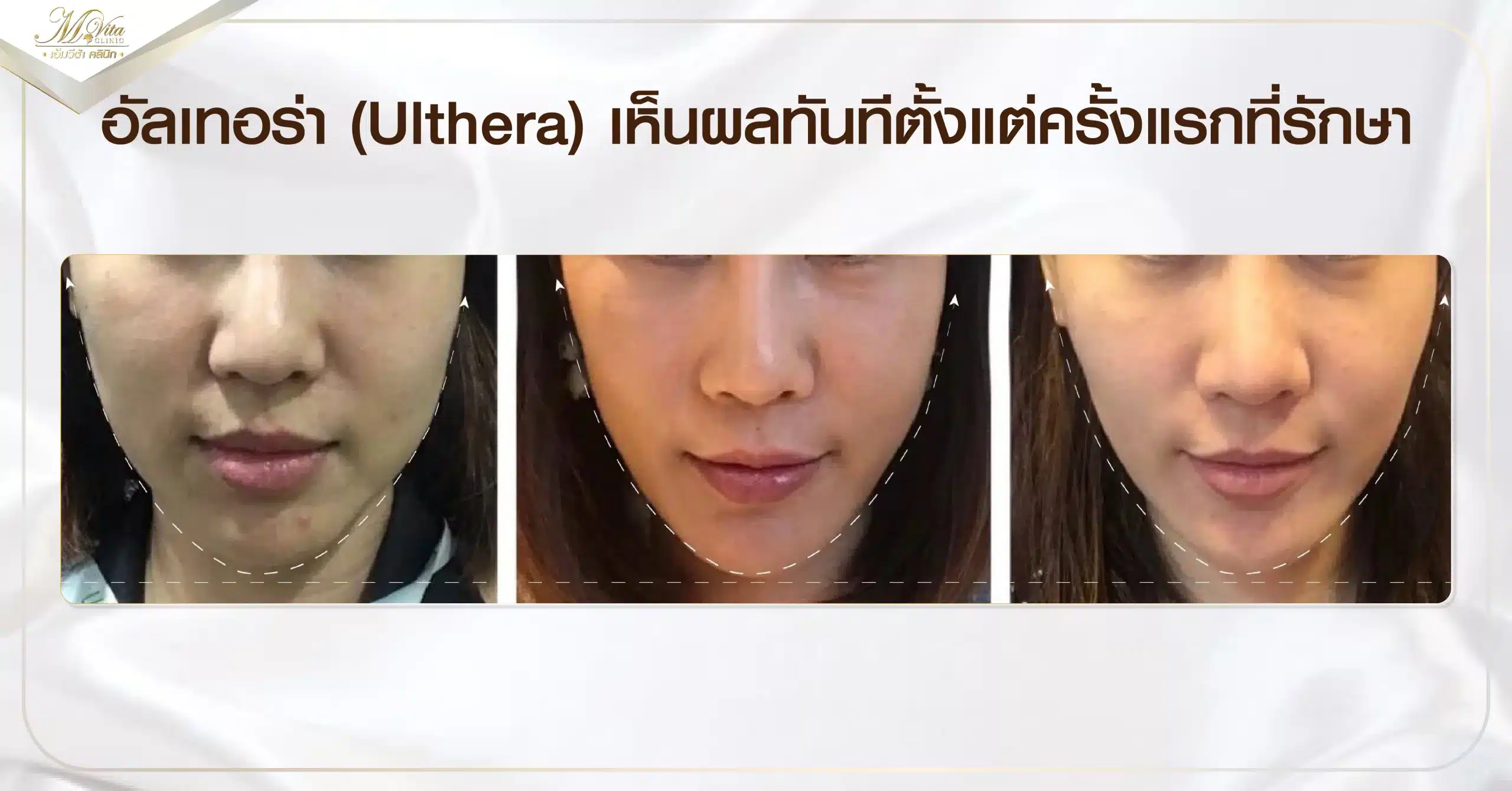 อัลเทอร่า (Ulthera) เห็นผลทันทีตั้งแต่ครั้งแรกที่รักษา