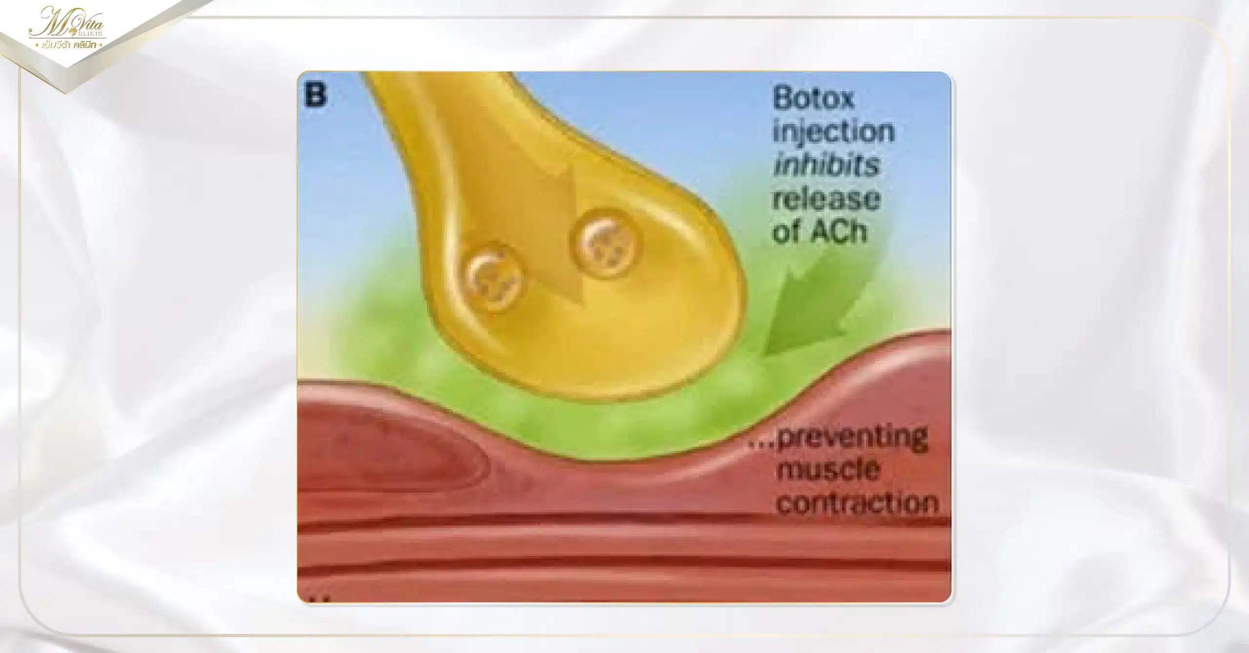 -โบท็อก (Botox) คืออะไร b