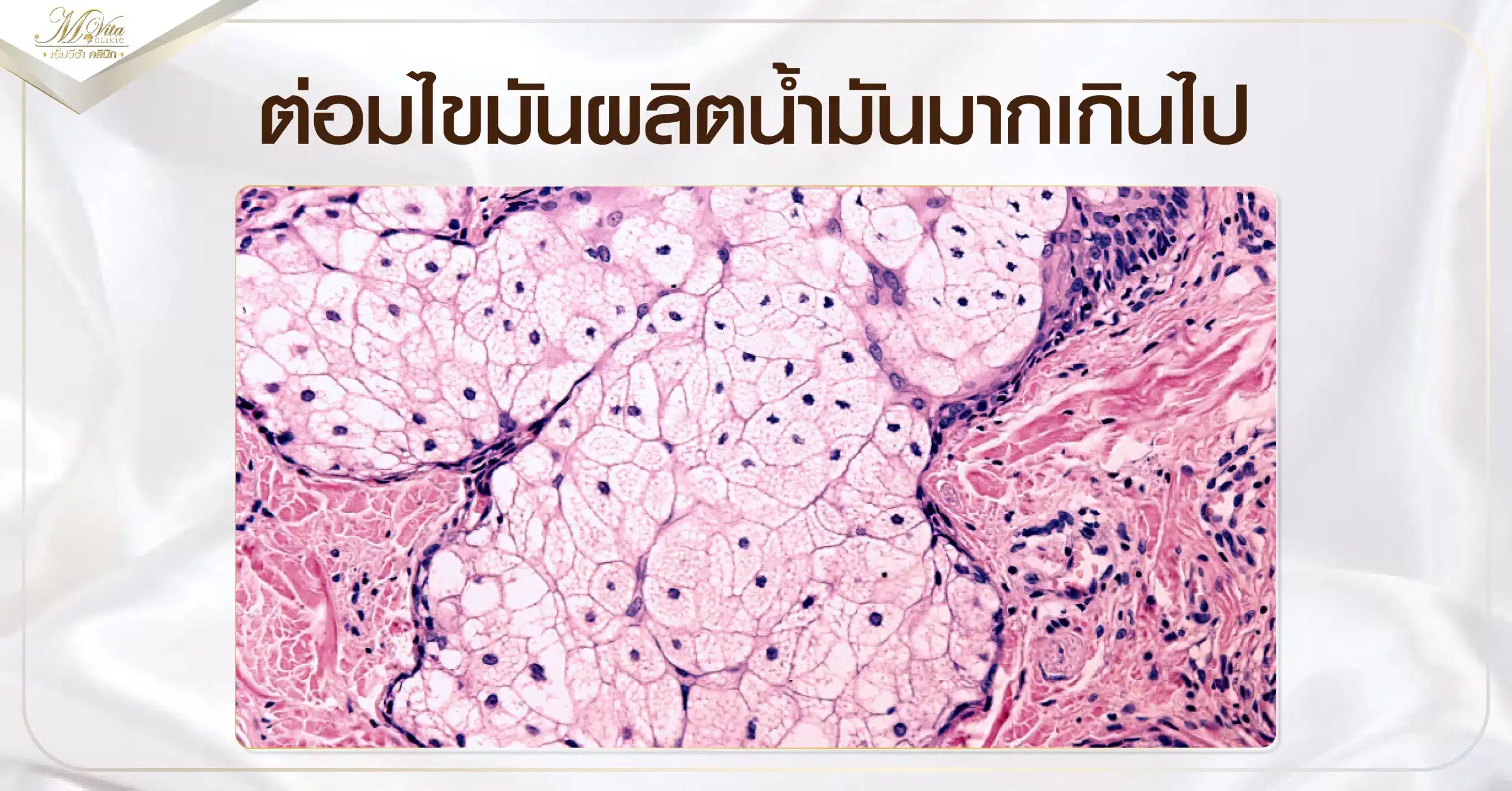 ต่อมไขมันผลิตน้ำมันมากเกินไป