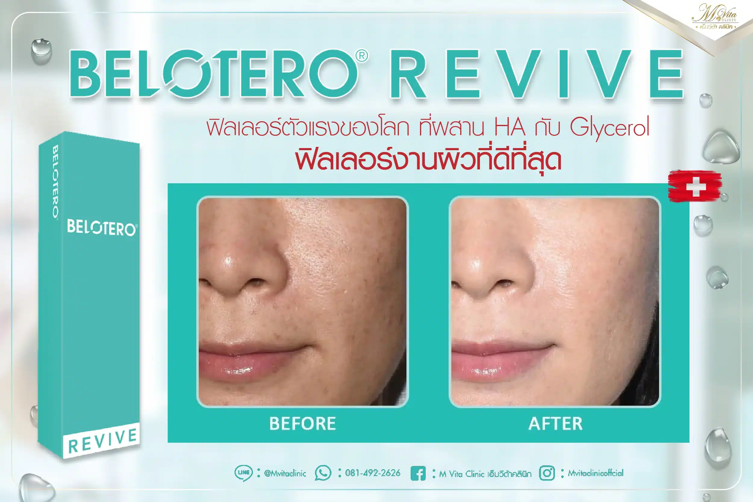 รีวิว Belotero Revive-01