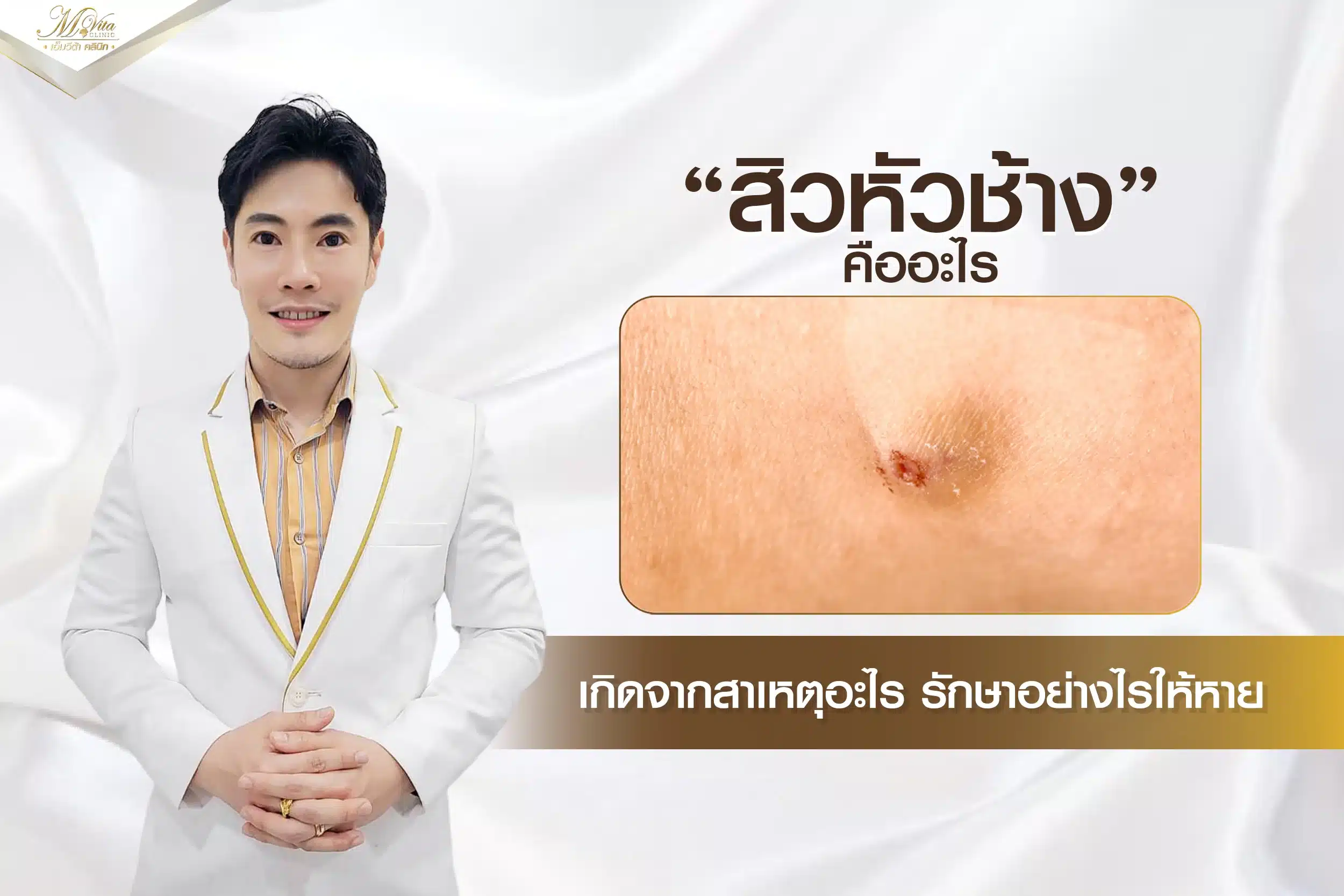 สิวหัวช้างรักษาอย่างไร? สาเหตุการเกิดคืออะไร?