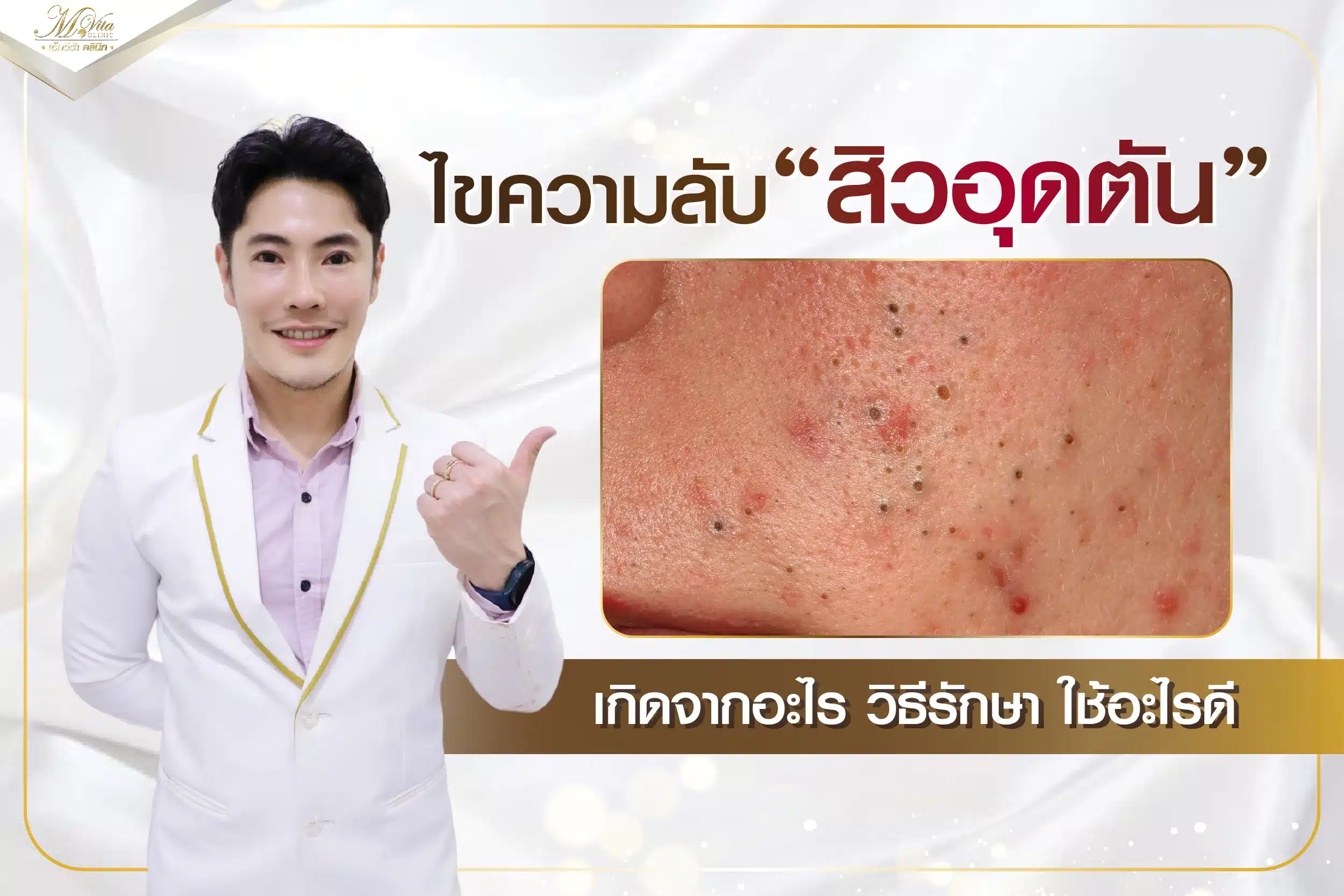 ไขความลับ! สิวอุดตัน เกิดจากอะไร วิธีรักษา ใช้อะไรดี