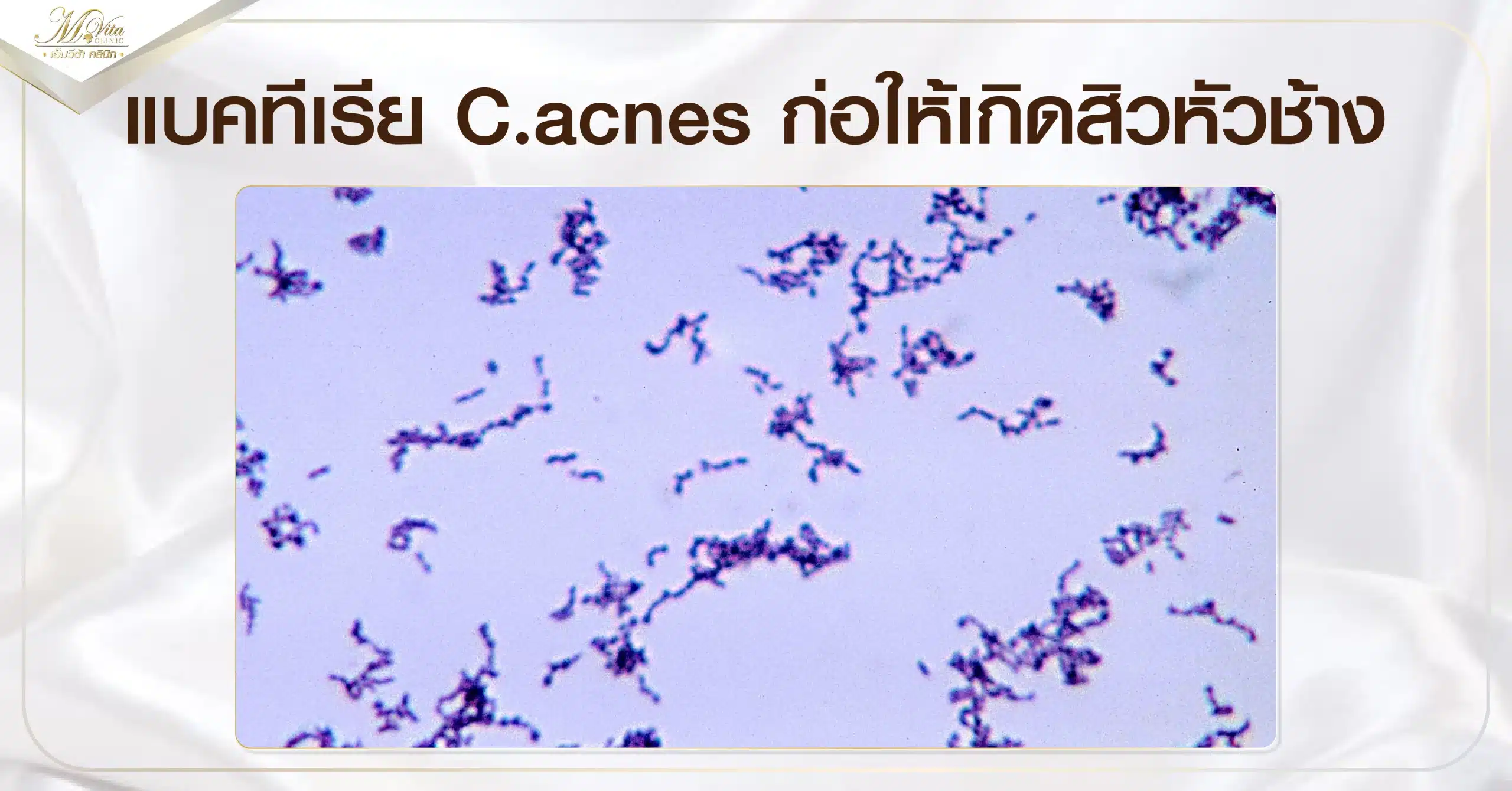 แบคทีเรีย C.acnes ก่อให้เกิดสิวหัวช้าง