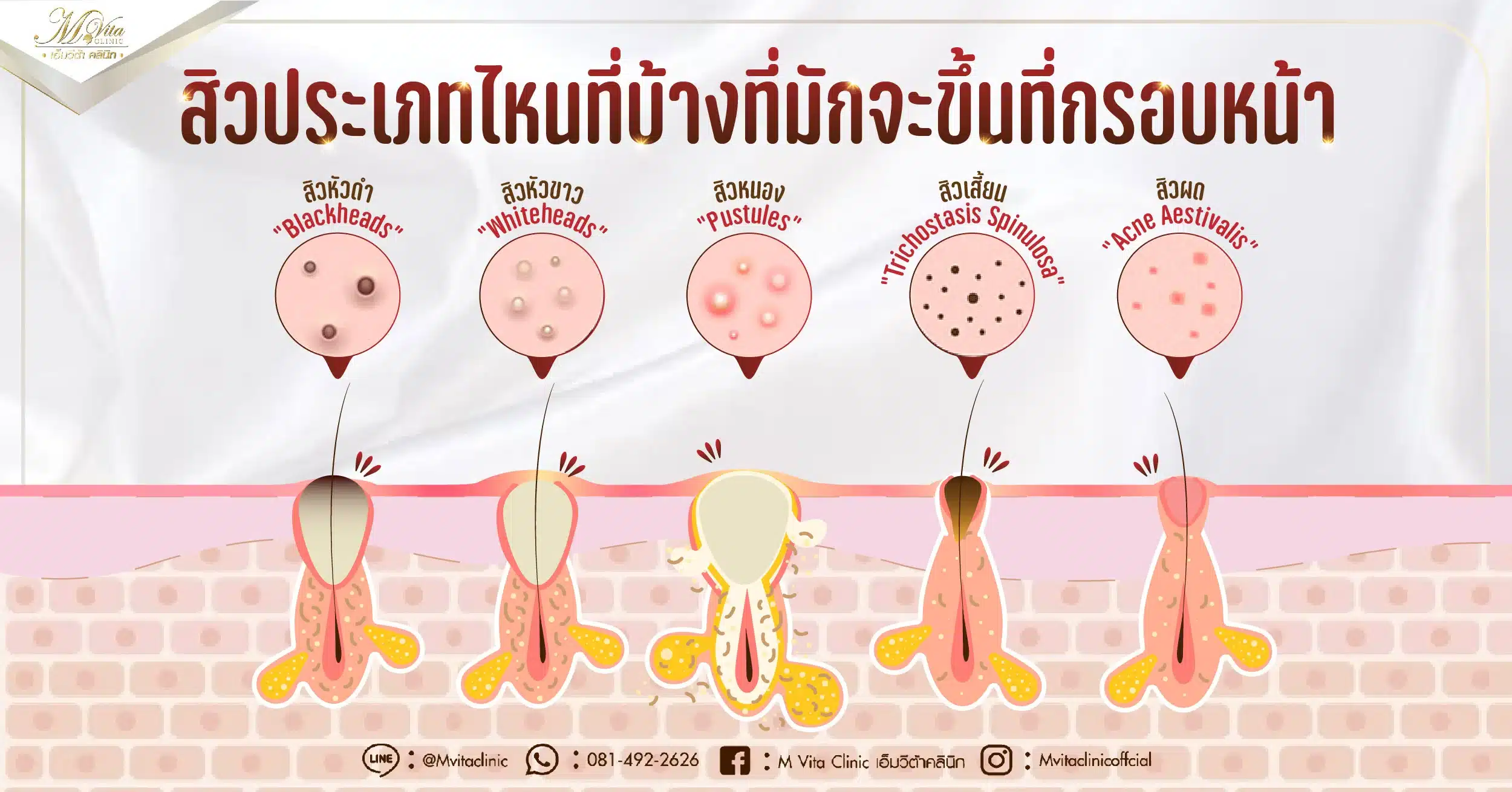 ชนิดของสิวกรอบหน้า-01