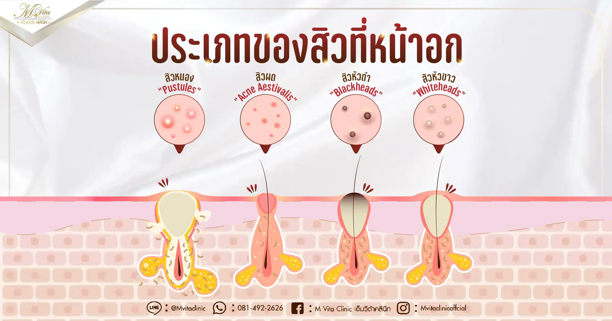 ชนิดของสิวที่หน้าอก