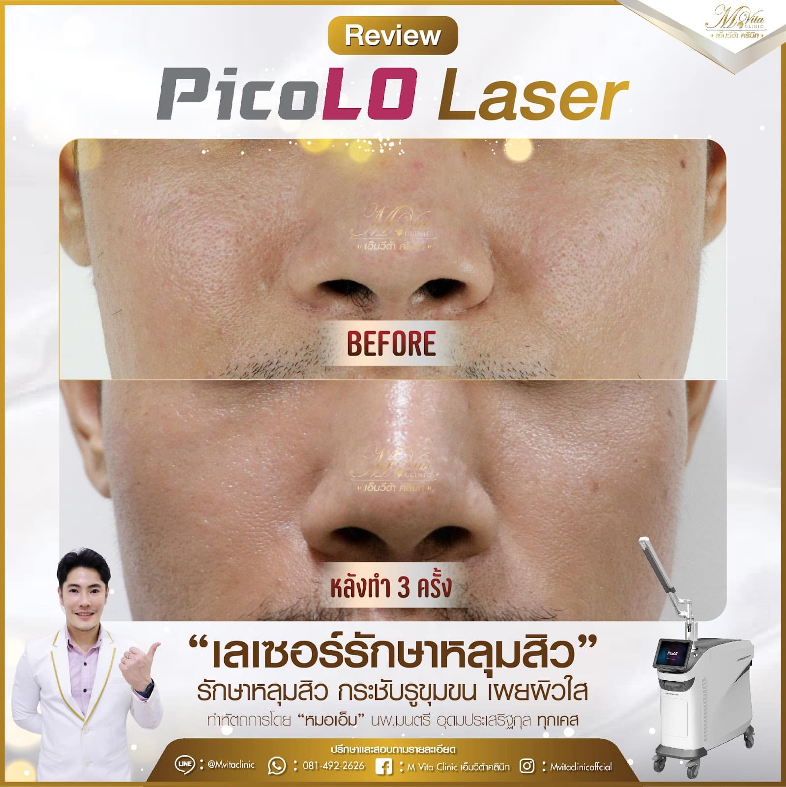 Picolo Laser รีวิว