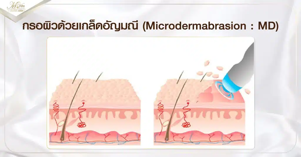 กรอผิวด้วยเกล็ดอัญมณี