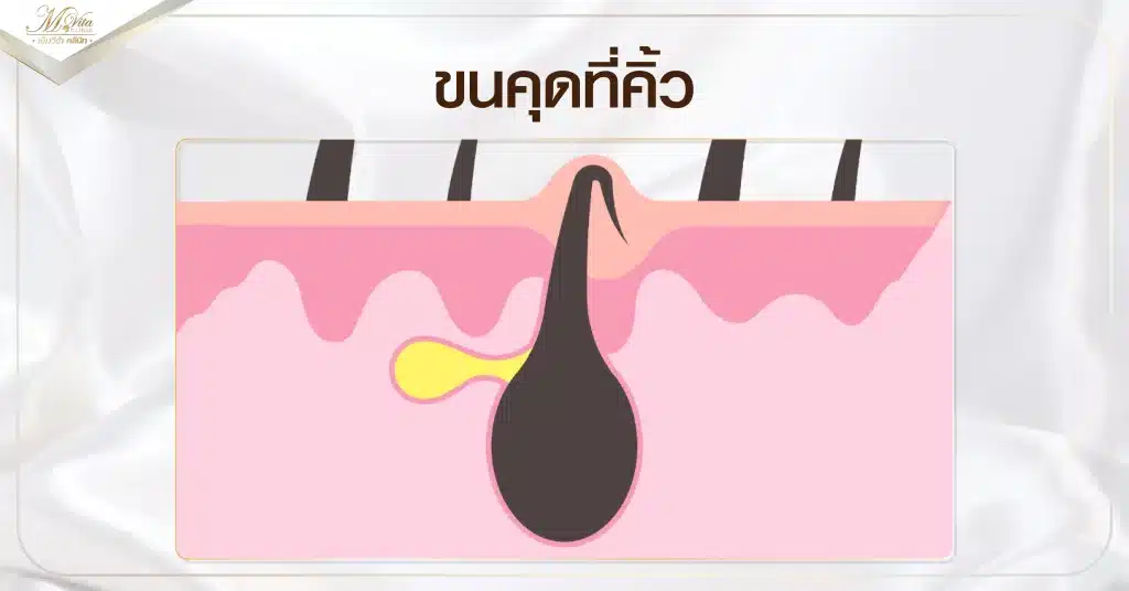 ขนคุดที่คิ้ว