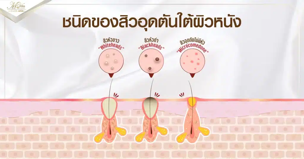 ชนิดของสิวอุดตันใต้ผิวหนัง