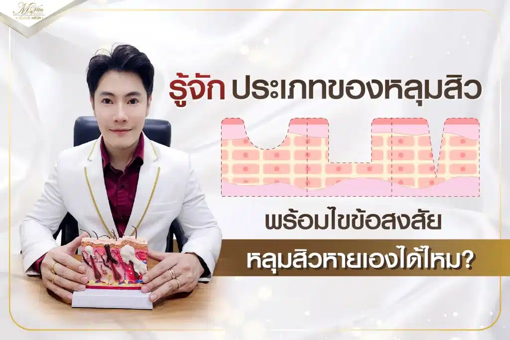 ประเภท ของ หลุมสิว